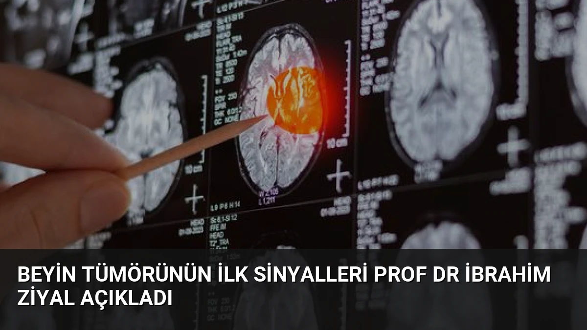 Beyin Tümörünün İlk Sinyalleri Prof Dr İbrahim Ziyal Açıkladı