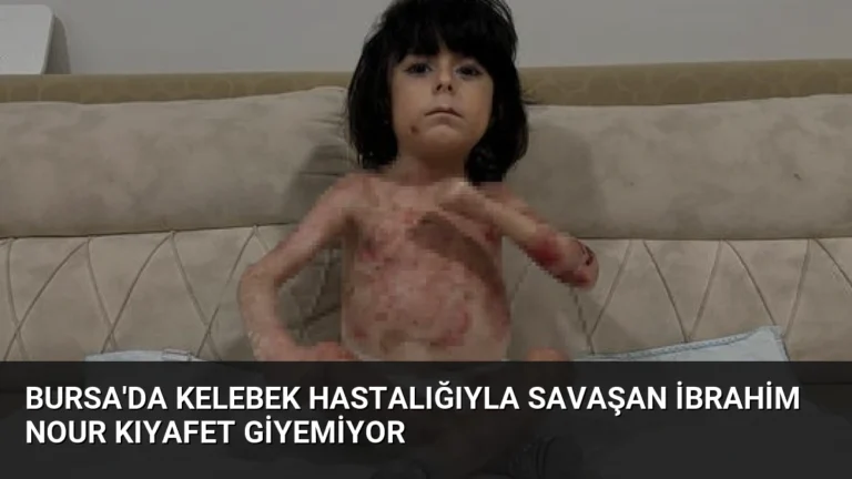 Bursa’da Kelebek Hastalığıyla Savaşan İbrahim Nour Kıyafet Giyemiyor