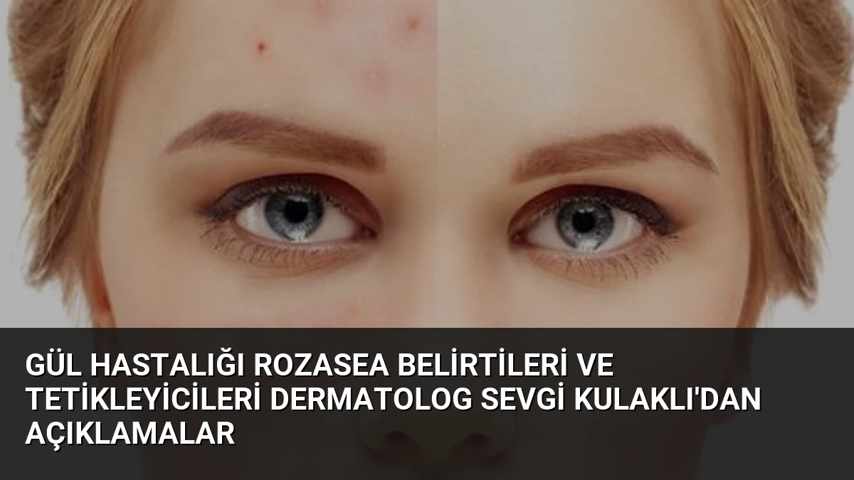 Gül Hastalığı Rozasea Belirtileri ve Tetikleyicileri Dermatolog Sevgi Kulaklı’dan Açıklamalar