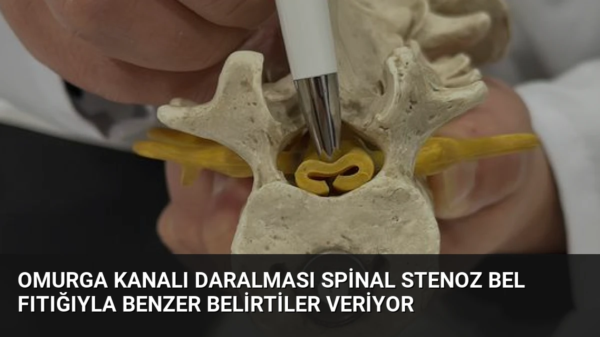 Omurga Kanalı Daralması Spinal Stenoz Bel Fıtığıyla Benzer Belirtiler Veriyor