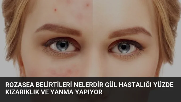 Rozasea Belirtileri Nelerdir Gül Hastalığı Yüzde Kızarıklık ve Yanma Yapıyor