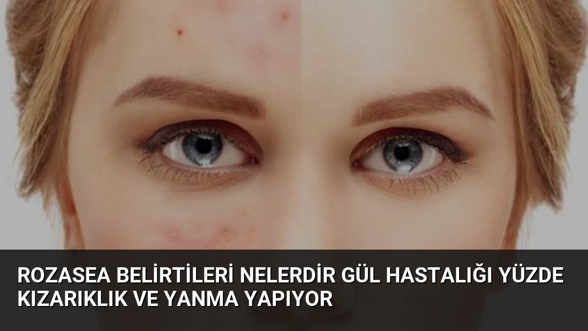 Rozasea Belirtileri Nelerdir Gül Hastalığı Yüzde Kızarıklık ve Yanma Yapıyor