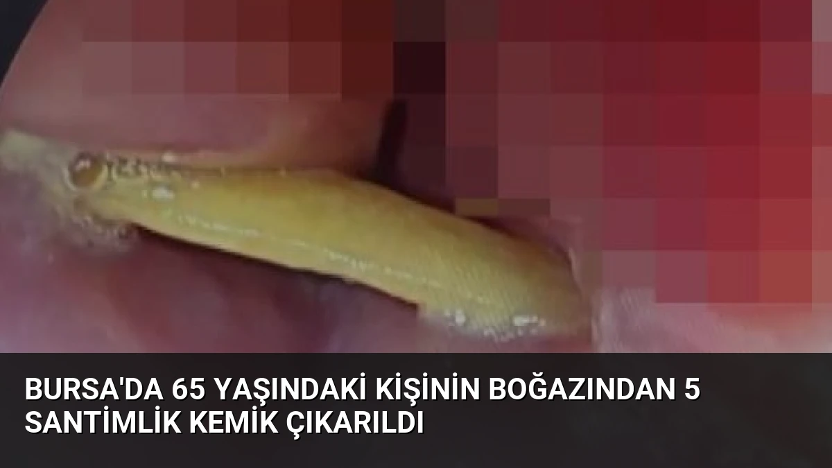 Bursa’da 65 Yaşındaki Kişinin Boğazından 5 Santimlik Kemik Çıkarıldı